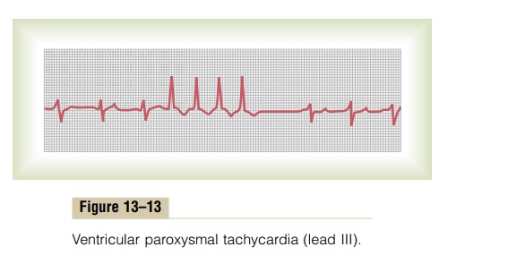 Ventricular Paroxysmal Tachycardia