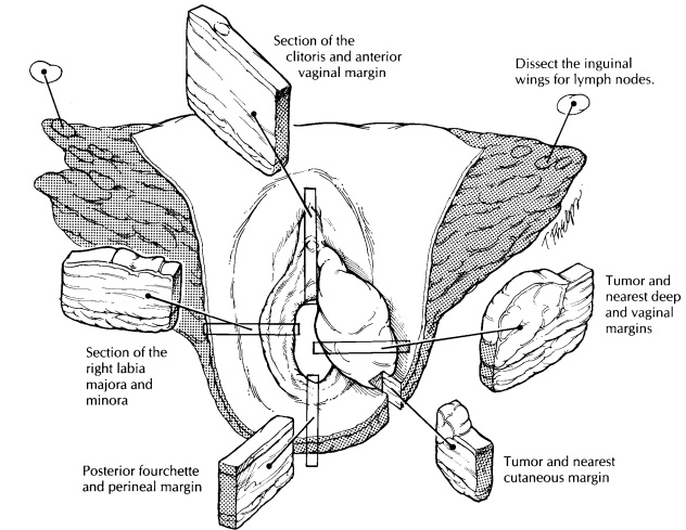 Vulva : Surgical Pathology Dissection