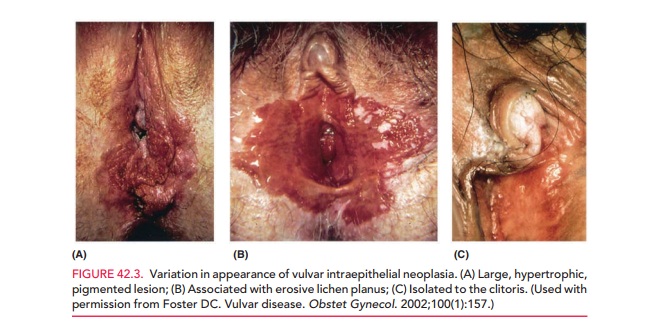 Vulvar Intraepithelial Neoplasia