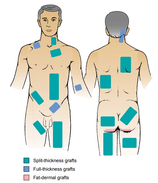 Wound Coverage: Grafts and Flaps