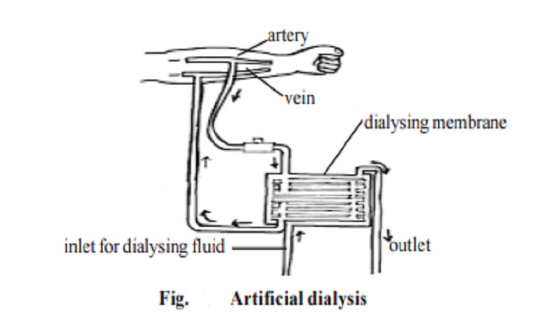 Renal Failure, Dialysis and Kidney Machines