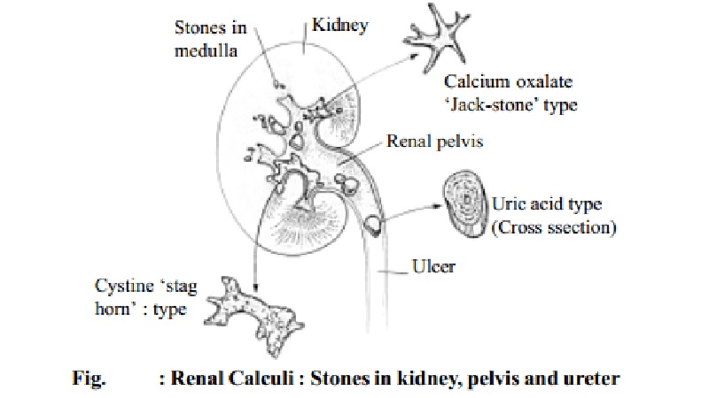 Dietary Management In Urinary Calculi(kidney stones) - Urolithiasis