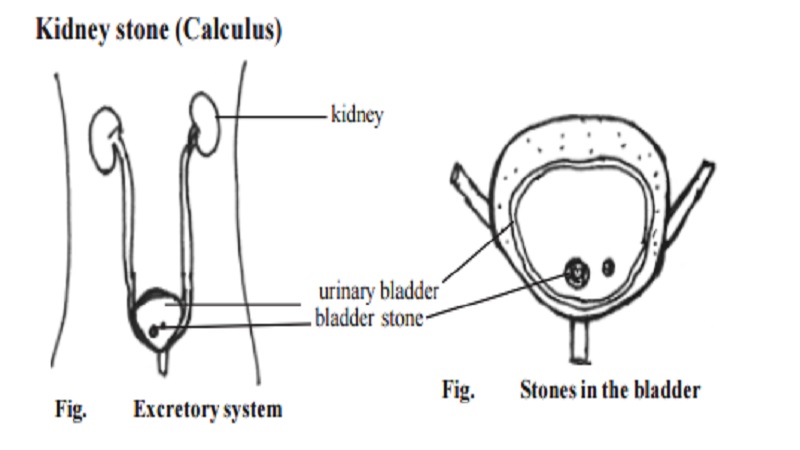 Human Kidney stone (Calculus) And Kidney transplantation