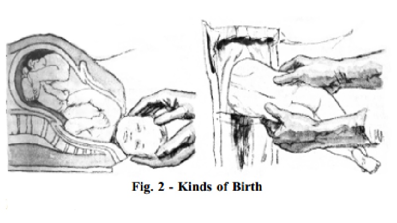 Kinds of child birth