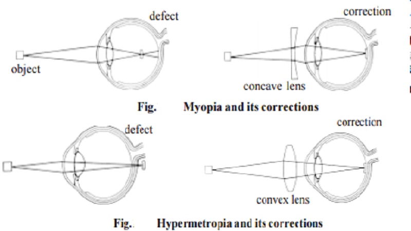 Human eye : Errors of refraction