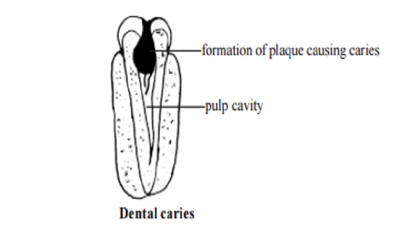 Dental Caries (Tooth decay) : Symptoms, Root Canal Treatment