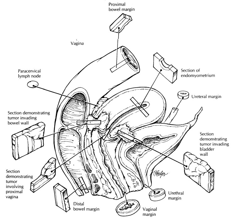 Radical Hysterectomy For Cervical Cancer