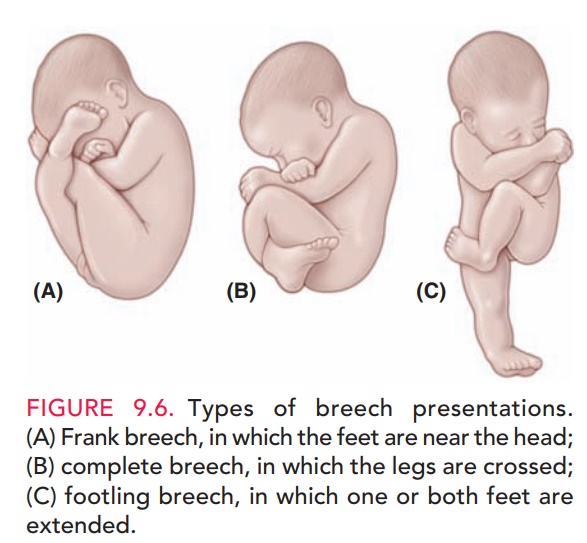 breech presentation at birth icd 10