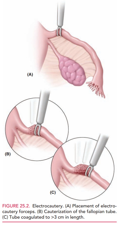 PDF) Failed tubectomy procedures: a retrospective study