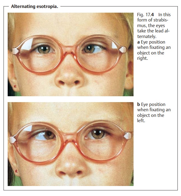 Forms Of Concomitant Strabismus