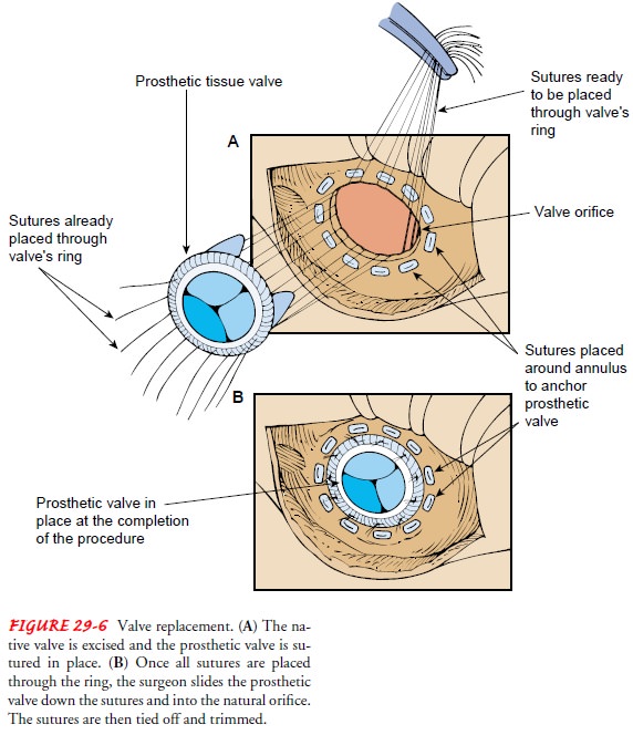 Frontiers | Emerging Technologies for Percutaneous Mitral Valve Repair