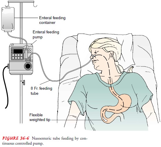 NG Tube Nursing Diagnosis and Care Plan